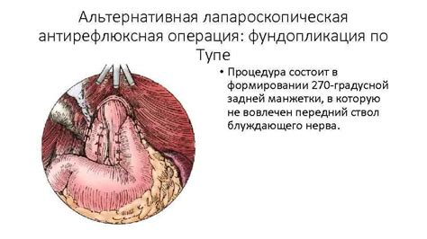 Методы лечения короткого пищевода