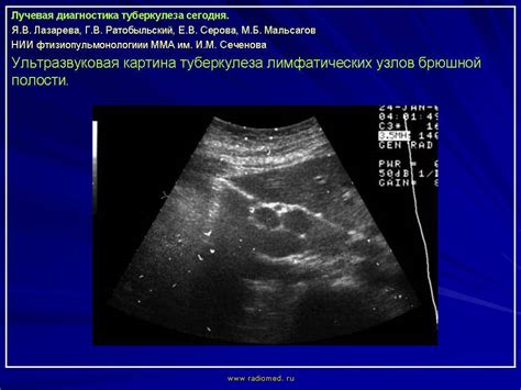 Методы лечения лимфаденопатии у ребенка