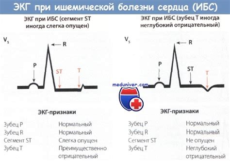 Методы лечения неспецифической депрессии ST сердца