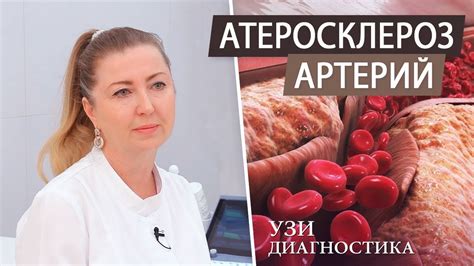 Методы лечения нестенозирующего атеросклероза артерий шеи