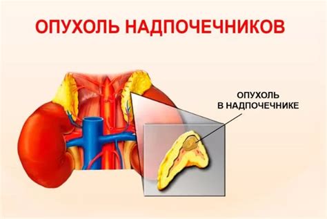 Методы лечения новообразования надпочечника