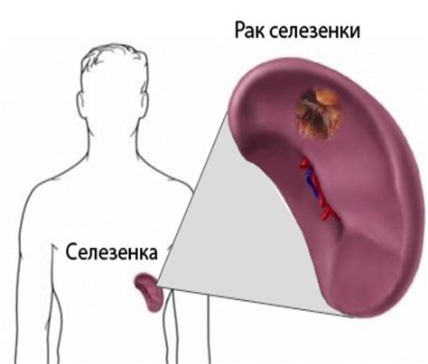 Методы лечения опухоли селезенки