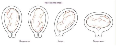 Методы лечения плотной плаценты