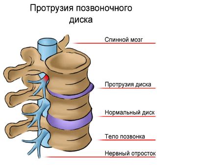 Методы лечения протрузии