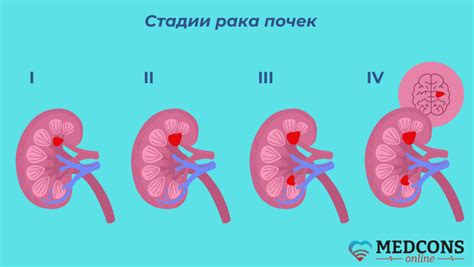 Методы ранней диагностики рака почки с 64