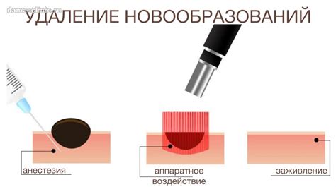 Методы удаления кератом