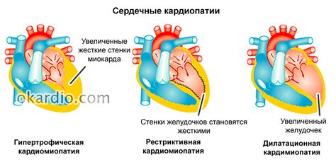 Механизм развития увеличения гоффа