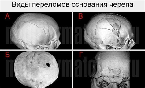 Механические повреждения черепа: симптомы и последствия