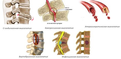 Миелопатия позвоночника: симптомы, причины и методы лечения