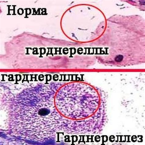 Микоплазма и уреаплазма: причины, симптомы, лечение, профилактика