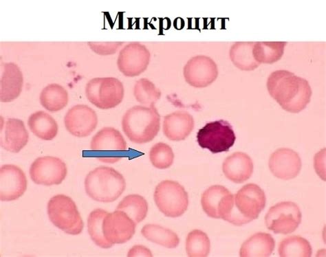 Микроциты: что это такое?