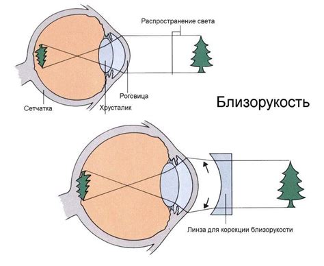 Минусовое зрение: проблемы и решения