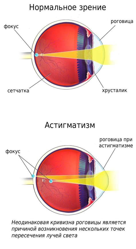 Миопический астигматизм: причины, симптомы, лечение