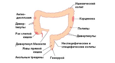 Может ли женское заболевание стать причиной кровавых выделений из прямой кишки?