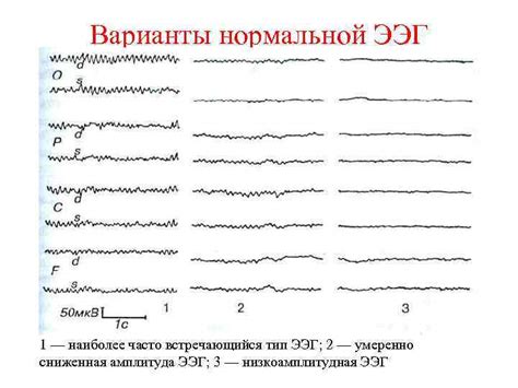 Можно ли вылечить умеренно дезорганизованный тип ээг?