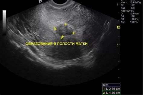 М-эхо 8 мм: значимость для эндометрия