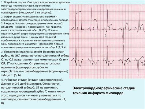 НДЖП на ЭКГ: общие сведения