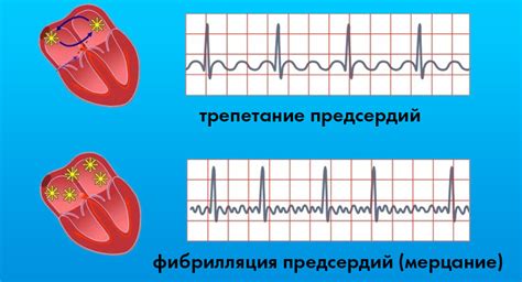 Нагрузка на ПП-кардиограмма: суть и проведение