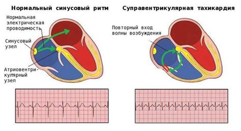 Наджелудочковая экстрасистолия: понятие и проявление