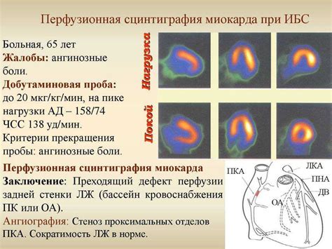 Назначение нагрузочной сцинтиграфии миокарда