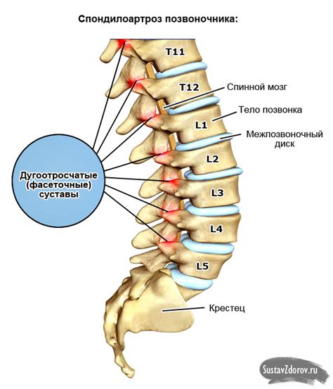 Наиболее характерные симптомы литического поражения позвоночника