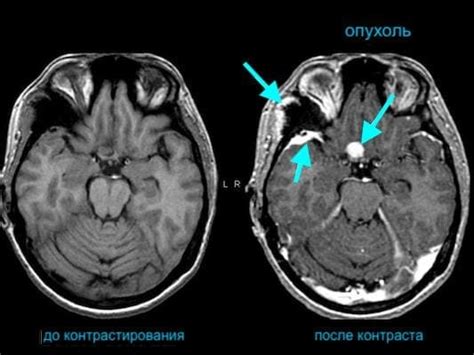 Накапливание контраста при КТ: сигналы и их интерпретация