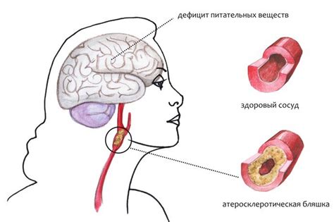 Народные методы лечения энцефалопатии 3 стадии