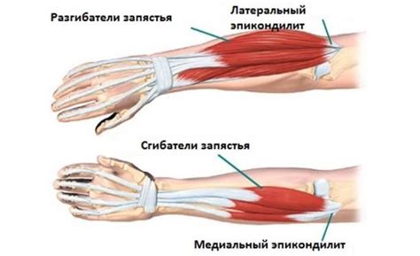 Наружный эпикондилит локтевого сустава