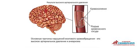 Нарушение кровообращения: что это такое?