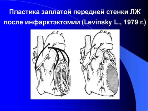 Нарушение локальной сократимости миокарда левого желудочка