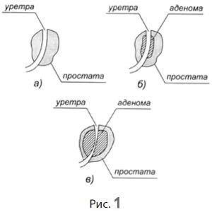 Нарушение работы предстательной железы кишечника