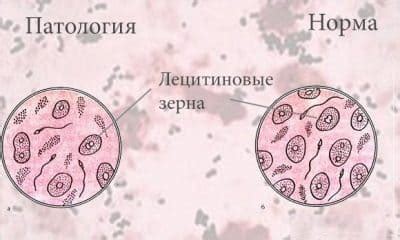 Нарушения процесса синтеза лецитиновых зерен