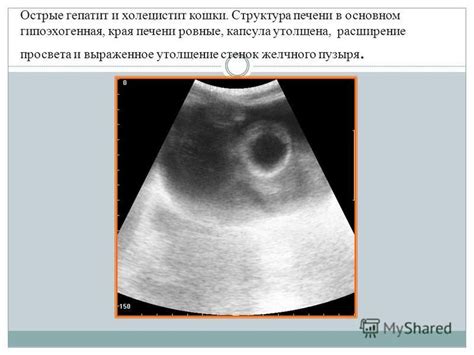 Наследственные факторы и утолщение стенок печени