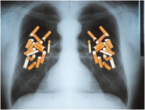 Научные исследования о связи между привычкой к курению и рентгеновскими снимками легких