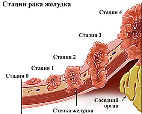 Начальные стадии рака желудка