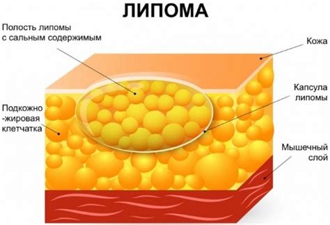 Невромы и цисты как возможные причины образования шишек под кожей