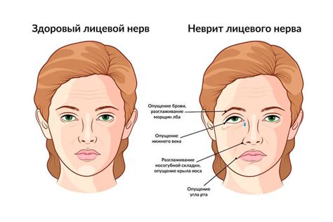 Невропатия локтевого нерва