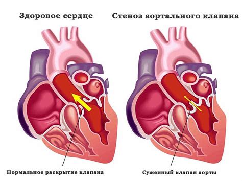 Недостаточность аортального клапана 2-3 степени и методы лечения