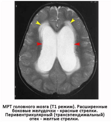 Незначительно выраженная наружная гидроцефалия головного мозга