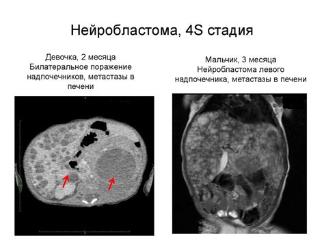 Нейробластома: определение и характеристика