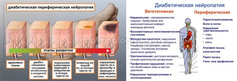 Нейропатия нижних конечностей при сахарном диабете