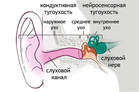 Нейросенсорная несиндромальная тугоухость