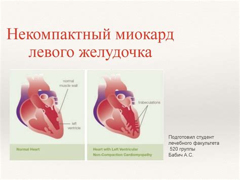 Некомпактный миокард: что это и его характеристики