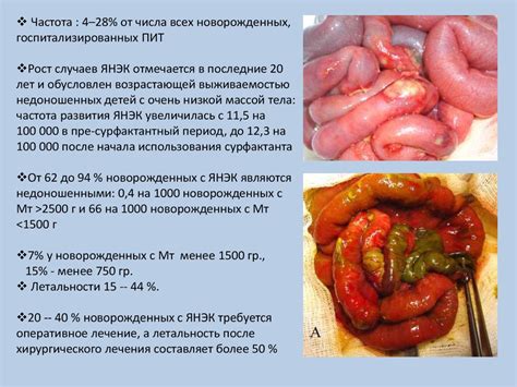 Некротический энтероколит у детей