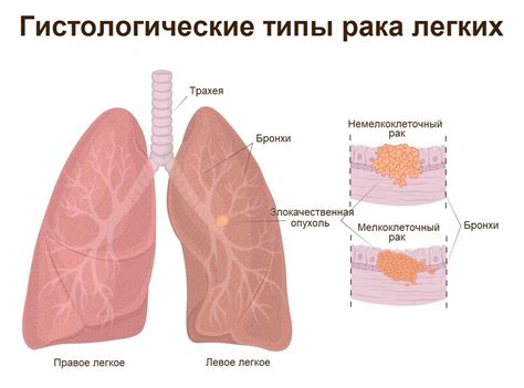 Немелкоклеточный рак: понятие и классификация