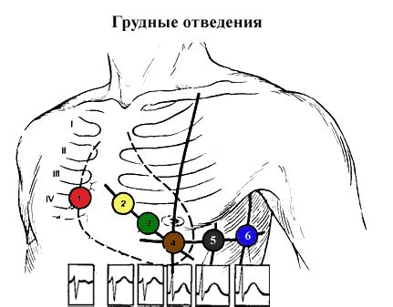 Необходимость проведения дополнительных мероприятий при обнаружении смещения грудных электродов