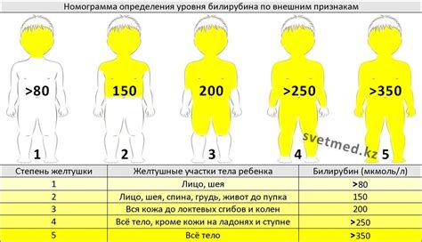 Неонатальная желтушка новорожденных