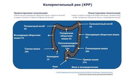 Неоплазия сигмовидной кишки