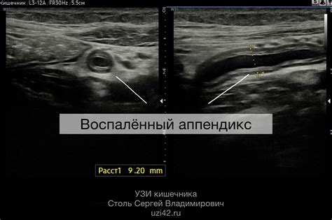 Неопределенность при УЗИ