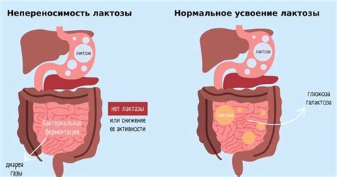 Непереносимость галактозы: причины, симптомы и лечение